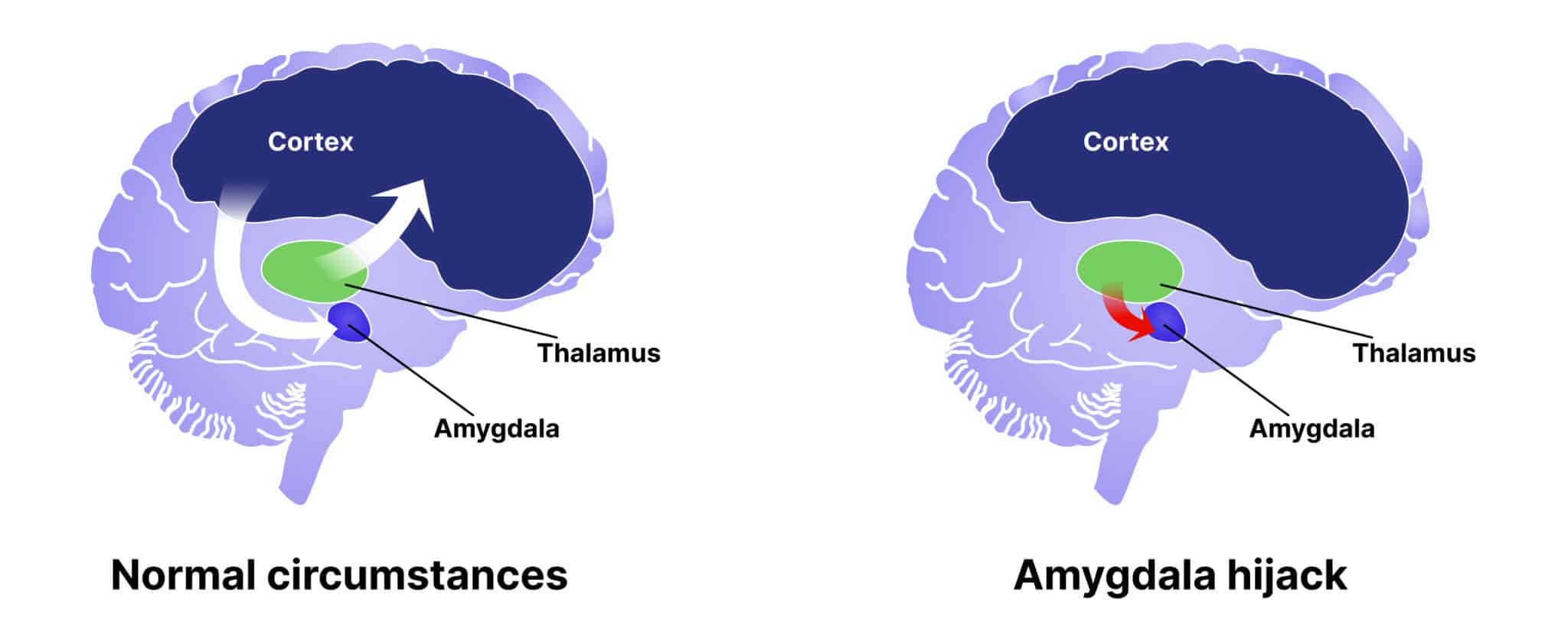 amygdala hijack